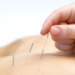 Acupuntura y Fisioterapia